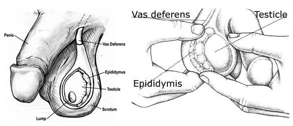 photo of illustration demonstrating testicular cancer self examination